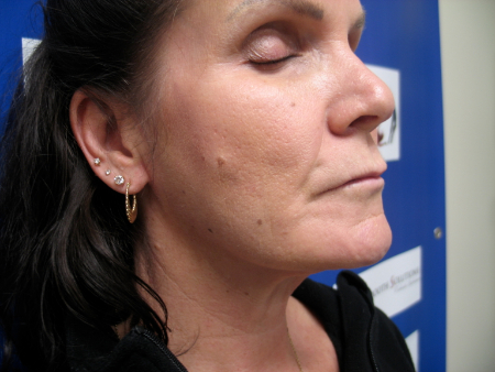 After Image: Patient # 27223 - 
