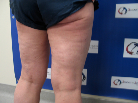 Before Image: Patient # 97912 - 