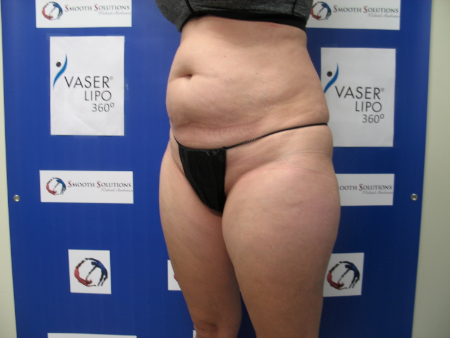 Before Image: Patient # 29790 - 