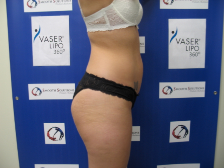 After Image: Patient # 51634 - 