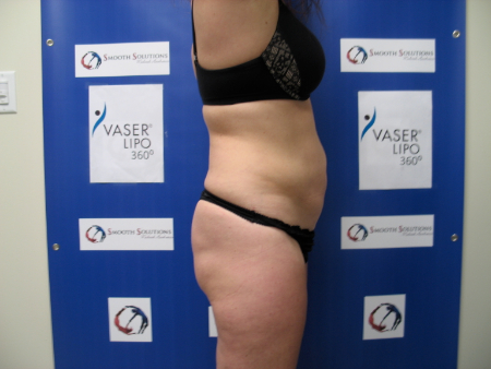 After Image: Patient # 38652 - 