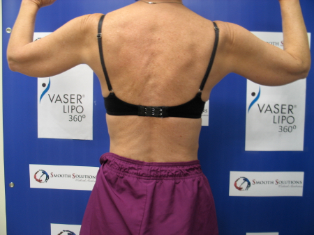 Before Image: Patient # 65717 - 