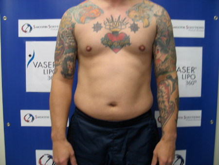 Before Image: Patient # 17387 - 