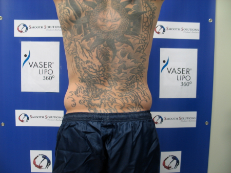 Before Image: Patient # 17387 - 
