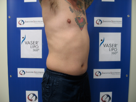 Before Image: Patient # 17387 - 
