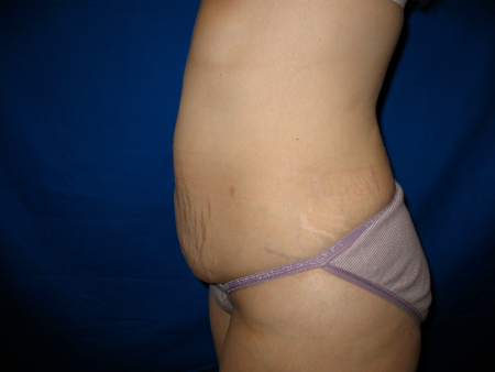 After Image: Patient # 29260 - 