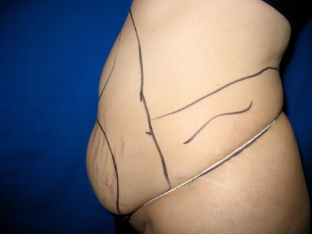 Before Image: Patient # 29260 - 