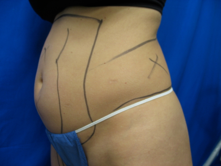 Before Image: Patient # 65833 - 