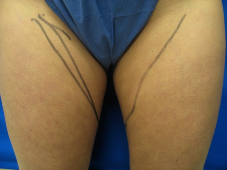 Before Image: Patient # 65833 - 