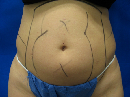 Before Image: Patient # 65833 - 