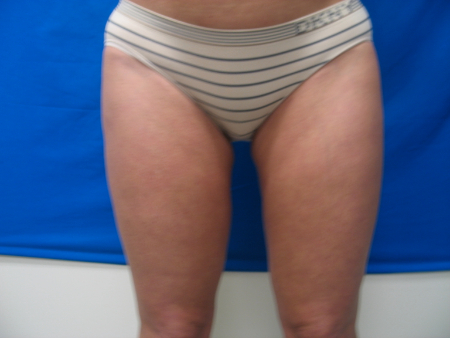 After Image: Patient # 65833 - 