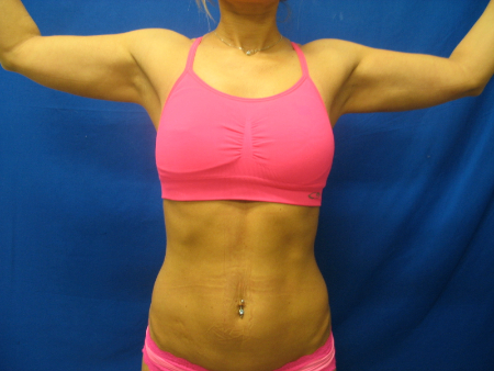 After Image: Patient # 84717-2 - front