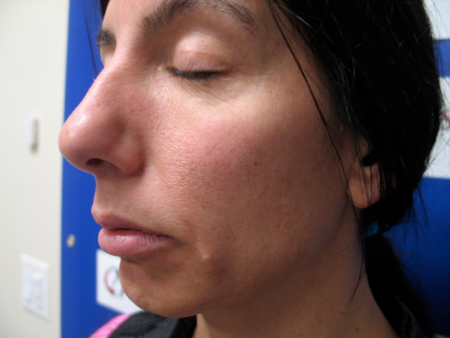 Before Image: Patient # 40495 - 