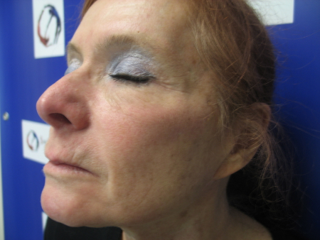 Before Image: Patient # 13235 - 