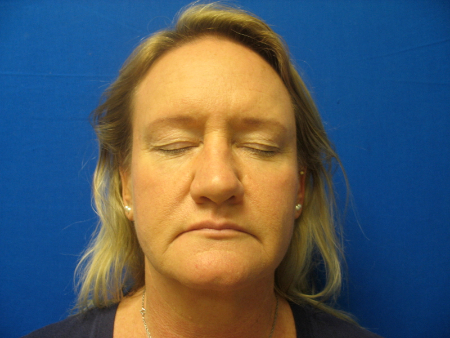 Before Image: Patient # 79085 - 
