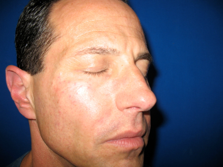 After Image: Patient # 98678 - 