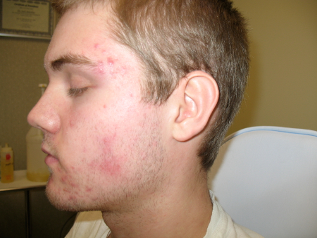 Before Image: Patient # 22454 - 