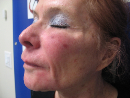 After Image: Patient # 13235 - 
