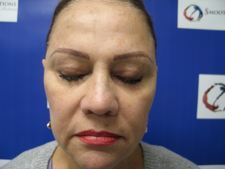 Before Image: Patient # 41933 - 