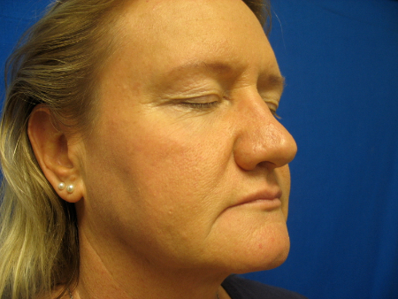 Before Image: Patient # 79085 - 