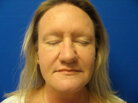 After Image: Patient # 79085 - 