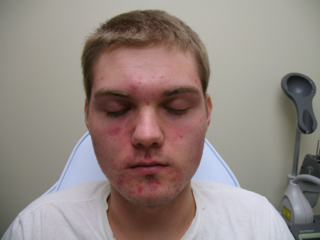 Before Image: Patient # 22454 - 