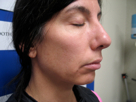 Before Image: Patient # 40495 - 