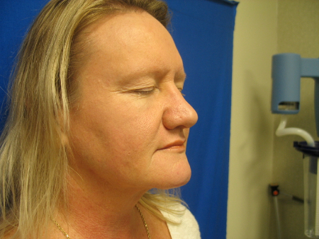 After Image: Patient # 79085 - 