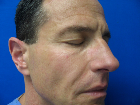 Before Image: Patient # 98678 - 