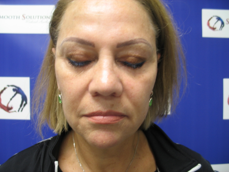 After Image: Patient # 41933 - 