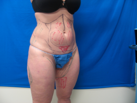 Before Image: Patient # 65571 - 