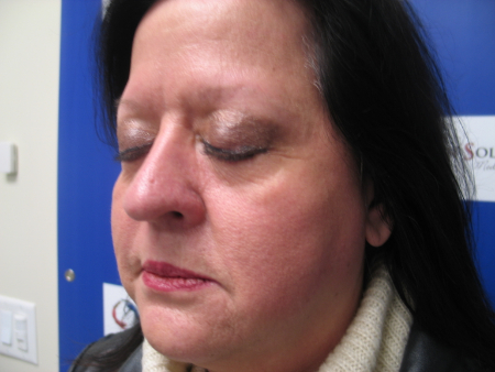 After Image: Patient # 19602 - 