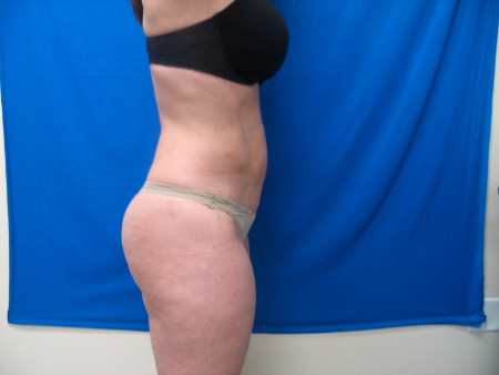 After Image: Patient # 65571 - 