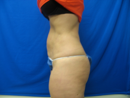 After Image: Patient # 65571 - 