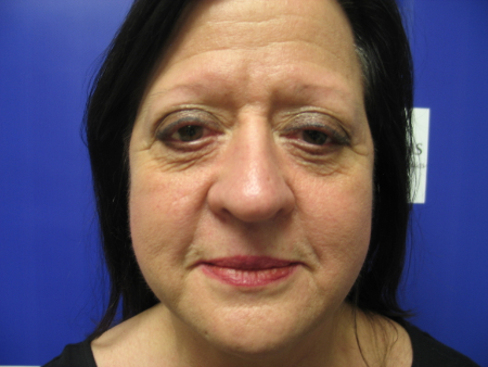 Before Image: Patient # 19602 - 