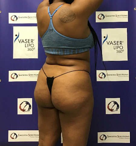 Before Image: Patient # 48526 - 