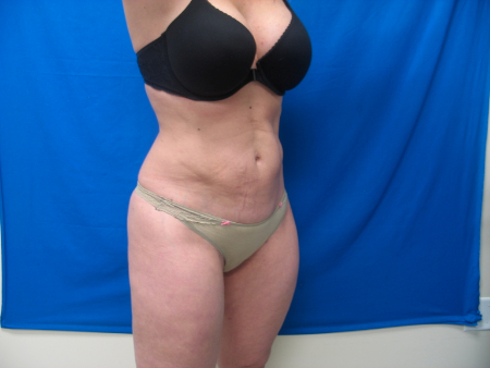 After Image: Patient # 65571 - 