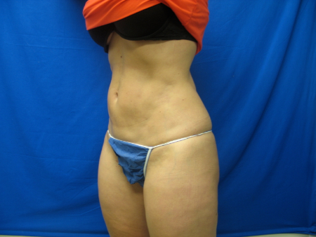 After Image: Patient # 65571 - 