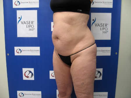 Before Image: Patient # 40152 - 
