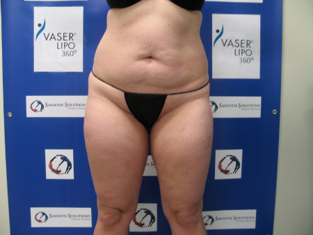 Before Image: Patient # 97884 - 