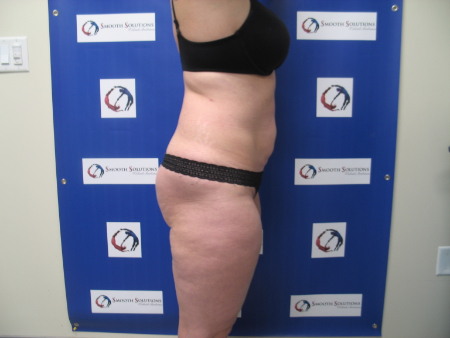 After Image: Patient # 97884 - 
