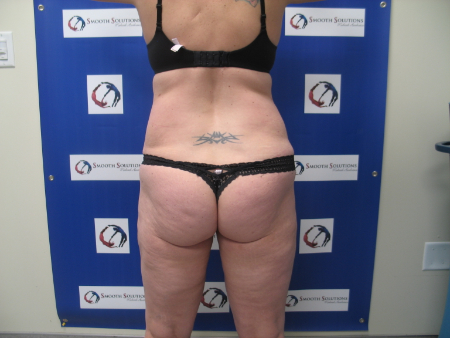 After Image: Patient # 97884 - 