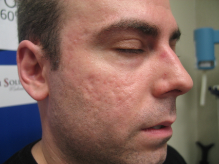 Before Image: Patient # 31166 - 
