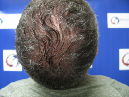 Before Image: Patient # 68433 - 