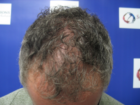 After Image: Patient # 68433 - 