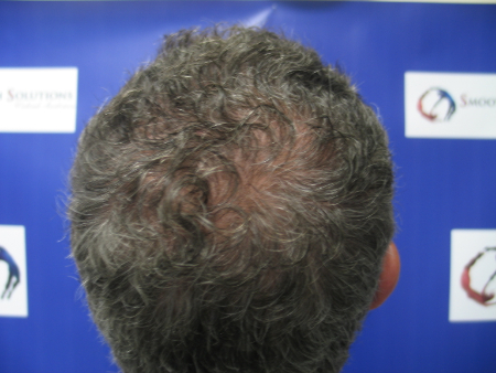 After Image: Patient # 68433 - 