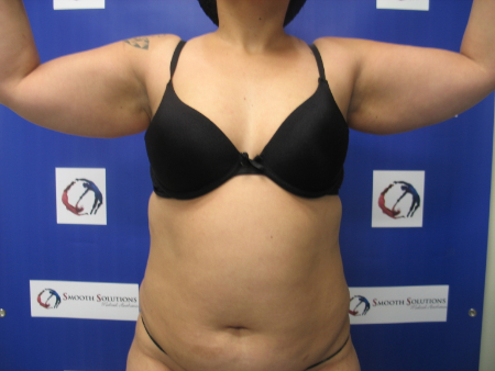 Before Image: Patient # 94244 - 