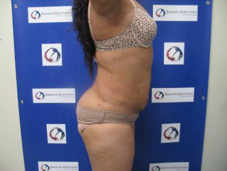 After Image: Patient # 94244 - 