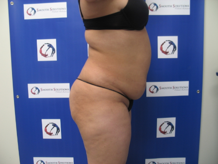 Before Image: Patient # 94244 - 