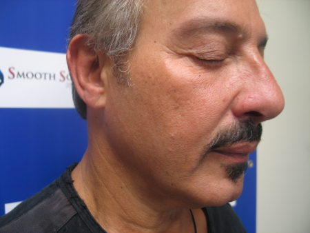 Before Image: Patient # 18077 - 